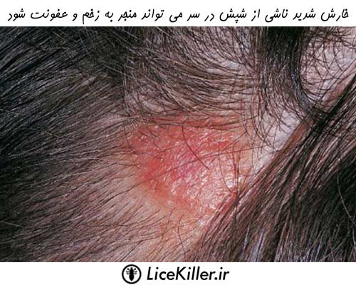 خارش شدید ناشی از شپش در سر می تواند به زخم و عفونت تبدیل شود