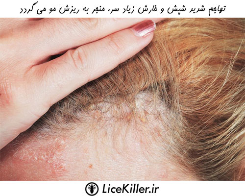 تهاجم شدید شپش و خارش زیاد پوست سر می تواند منجر به ریزش مو گردد